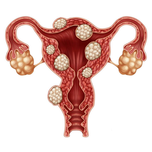 Uterine-fibroids